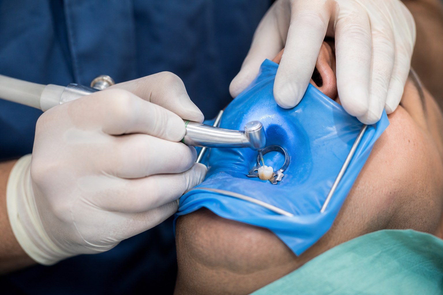 Endodontic Services at North York Dental