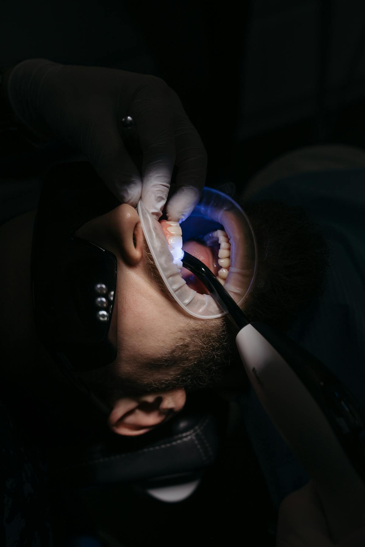 Tooth-Coloured Fillings at North York Dental