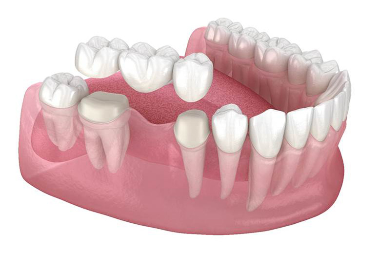 Digital illustration of a traditional dental bridge in North York