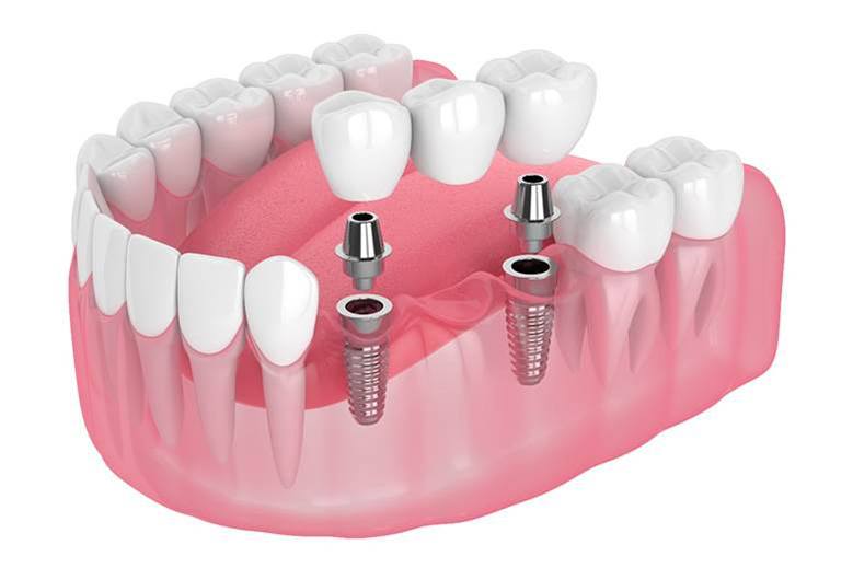 Digital illustration of an implant bridge in North York