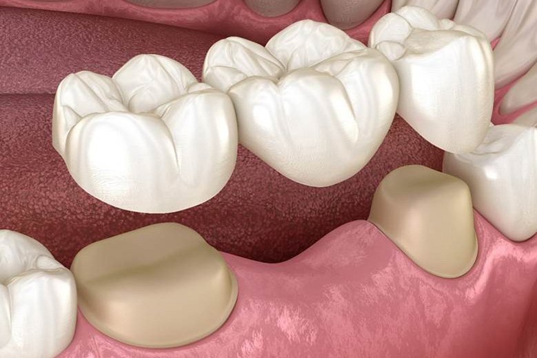 illustration of what it’s like to get a dental bridge in North York