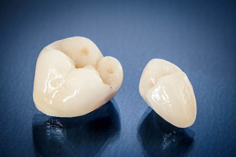 Close-up of two dental crowns in North York, ON