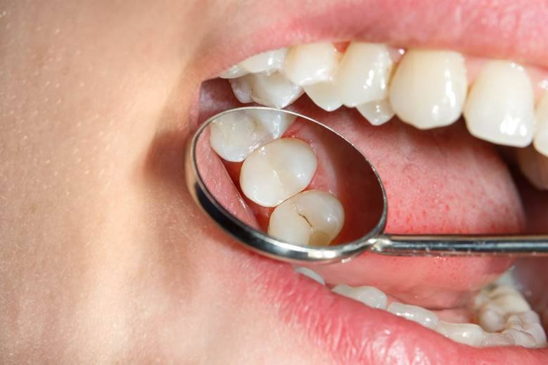 close up of patient with tooth-coloured fillings in North York