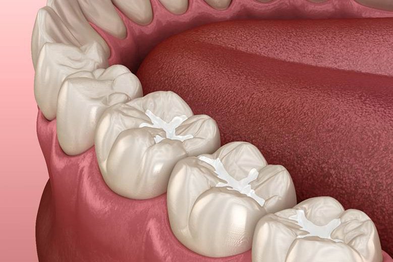digital illustration of tooth-coloured fillings in North York