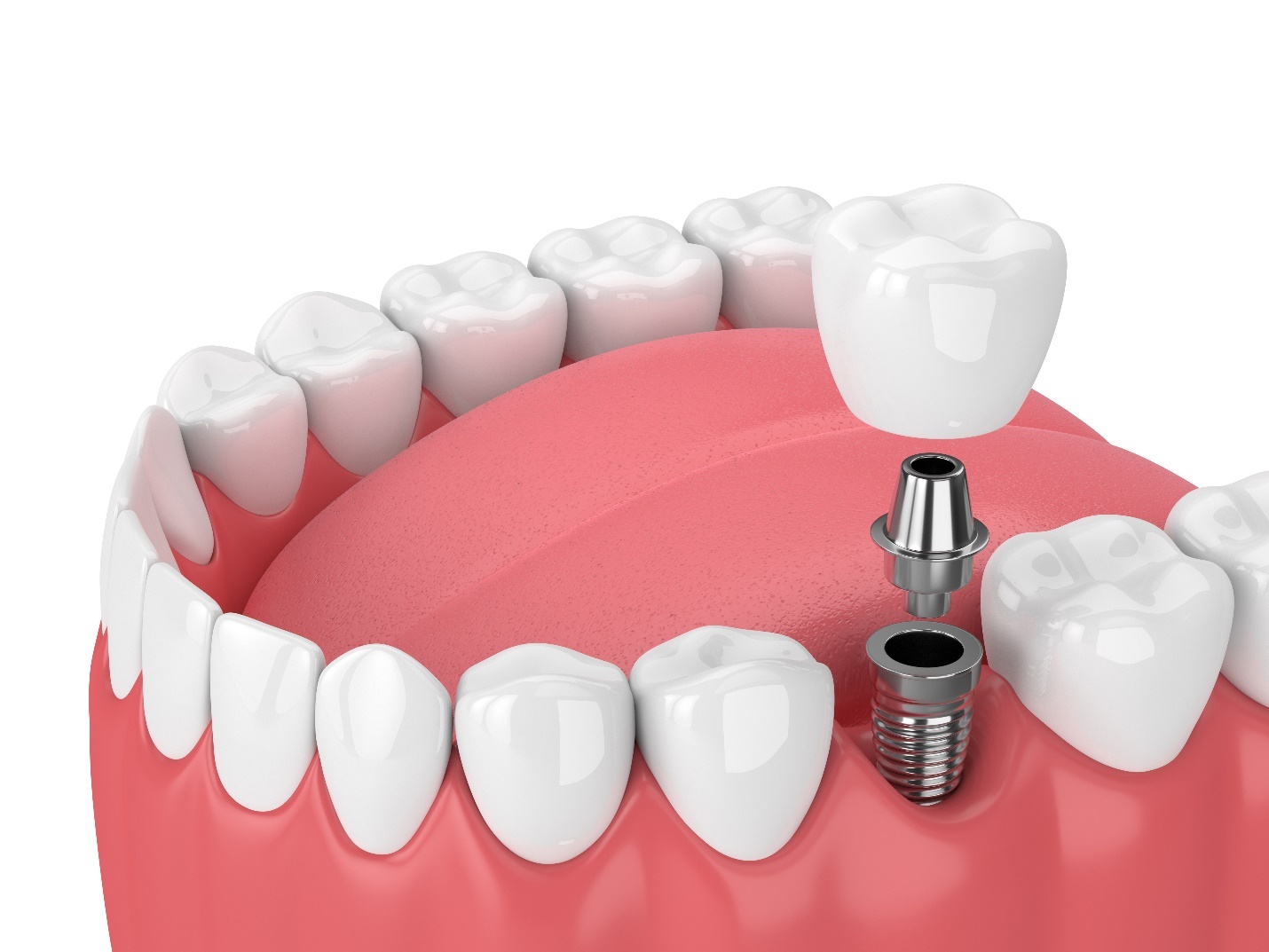 3D model of dental implant